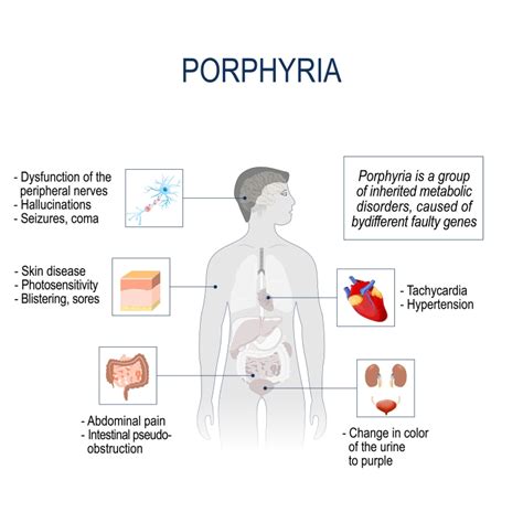 What is Porphyria? –Types, Causes, Symptoms, Treatment