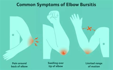 Elbow (Olecranon) Bursitis: Causes, Signs and Treatments - Sports Medicine Weekly By Dr. Brian Cole