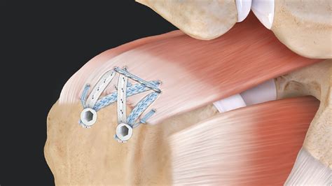 Arthrex - Compression SpeedBridge™ Rotator Cuff Repair