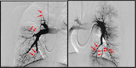 Pulmonary angiography. Angiography is a type of X-ray used to… | by Dem Ebs Backoffice | Medium