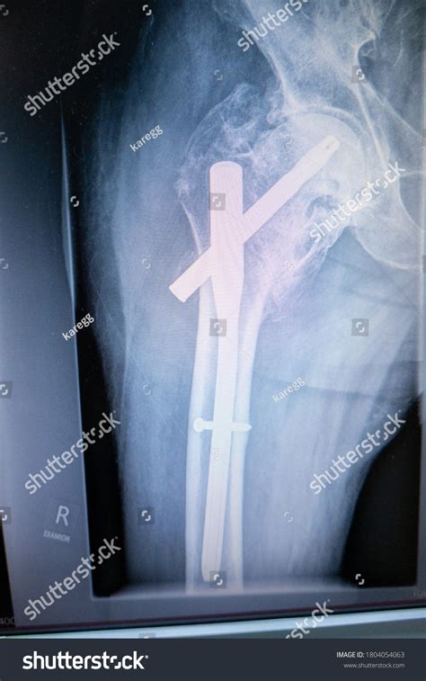 Xray Hip Implanted Femoral Nail Stock Photo 1804054063 | Shutterstock