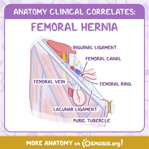 Lacunar Ligament Femoral Hernia