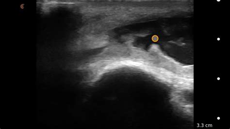 Olecranon Bursitis - Clarius Mobile Health - 伟德客户端,伟德官方app下载,伟德官方下载有苹果版