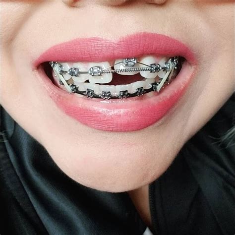 BRACES on Instagram: “#braces #braceson #bracesbeforeandafter #orthodontictreatment #ortho # ...