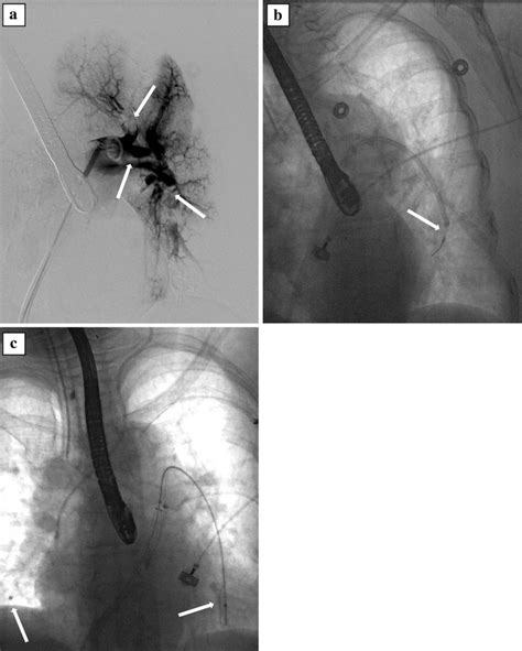 Representative case of catheter directed therapy. a Left pulmonary... | Download Scientific Diagram