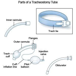 Tracheostomy Care - What You Need to Know