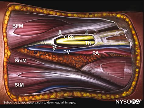 Popliteal sciatic nerve block - NYSORA Learning management system