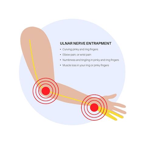 Premium Vector | Ulnar nerve entrapment