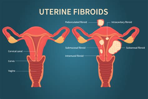 Uterine Fibroid Embolization Ufe - Mark Fibroid Care