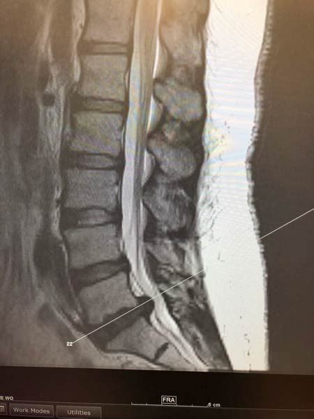 Lumbar Spine Mri Bulging Disc