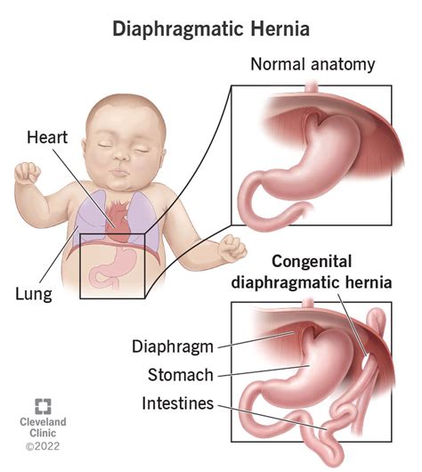 Congenital Diaphragmatic Hernia: Symptoms, Types & What It Is