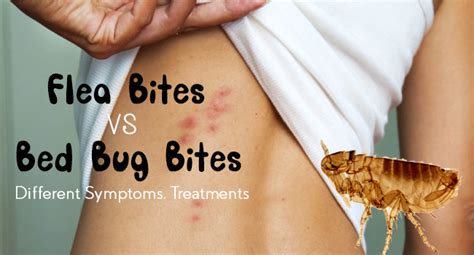 Flea Bites vs. Bed Bug Bites: Different Symptoms, Treatments - Allergy-symptoms.org