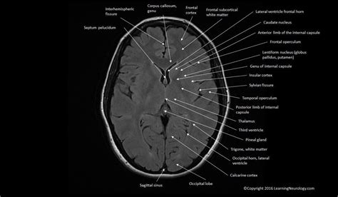 Approach to MRI brain | LearningNeurology.com | Mri brain, Mri, Neurological disorders brain