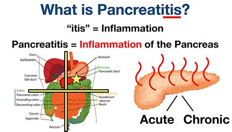 Pancreatitis Pain: Symptoms, Causes, Treatment, Diet, Location, Diagnosis, Acute vs Chronic — EZmed