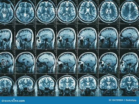 MRI Brain Scan or Magnetic Resonance of Head Image Results Editorial Stock Image - Image of ...