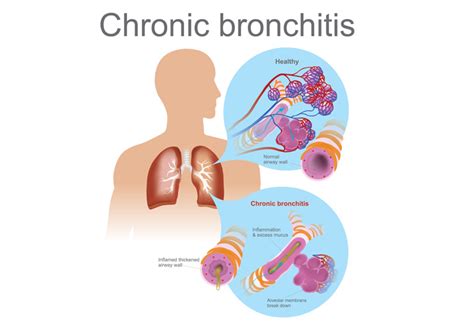 Amazing Info About How To Get Rid Of Bronchial Mucus - Effectsteak33