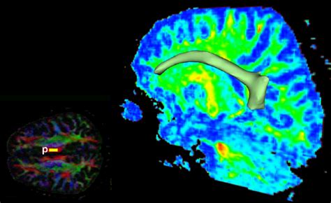 Right: Right cingulum segmented with estimated w d ang 1 = 1 . 0 , in a... | Download Scientific ...
