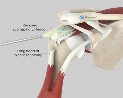 Can You Die From Rotator Cuff Surgery at Marcia George blog