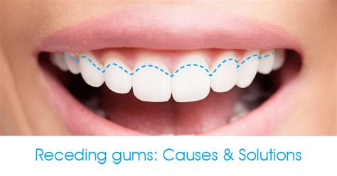 What Causes Receding Gums? | Farmer & Williamson