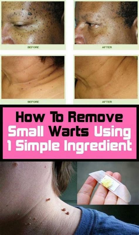 How To Remove Warts On Elbow - HOWTOREMVO