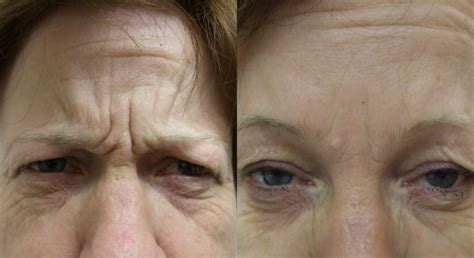 Botox Injection For Frown Lines Before and After