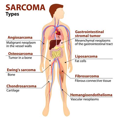 Sarcoma Cancer (Soft Tissue & Bone) - Deaf Cancer Support Group