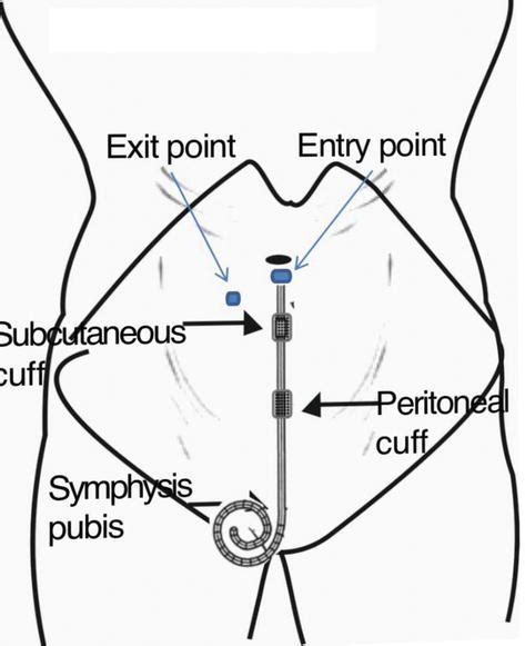 Techniques for Peritoneal Dialysis Catheter Placement | IntechOpen