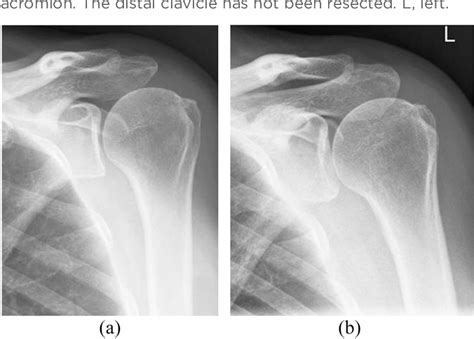 Figure 5 from Complications of rotator cuff surgery-the role of post-operative imaging in ...