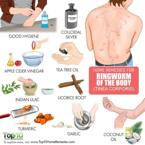 How to Get Rid of Ringworm (of the Body)