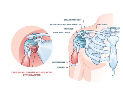 Dealing With Acromion Pain With The Best Exercises For Relief | Physiotherapists in Toronto ...