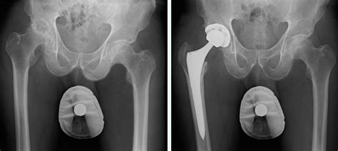 For Active Patients, Anterior Hip Replacement Surgery May Shorten Recovery - Healthy Practice