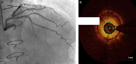 (A) Coronary angiography showing severe in-stent restenosis in the mid... | Download Scientific ...