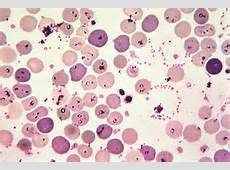 In the U.S., where the most cases of babesiosis have been recorded, Babesia microti is the ...