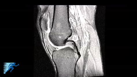 Meniscal Tear Knee Mri