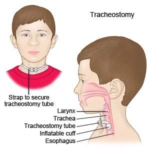 Tracheostomy Tube