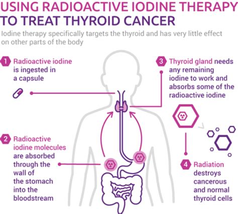 How can I prepare my thyroid for radioactive iodine treatment? [2022] | QAQooking.wiki