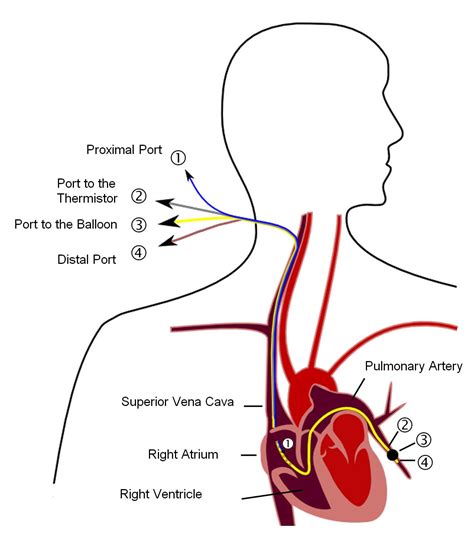 File:Pulmonary artery catheter english.JPG - Wikipedia