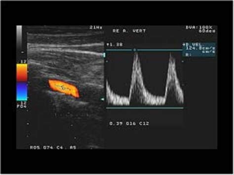 Peripheral vessels | 10.1 Peripheral arteries : Case 10.1.2 Vertebral artery and subclavian ...