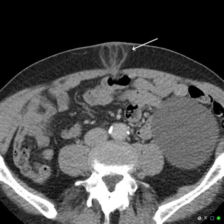 Umbilical Hernia Fat