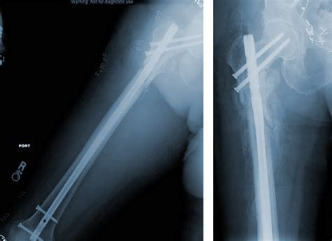 Antegrade Femoral Nail (AFN) uses, sizes, surgical technique • Vast Ortho