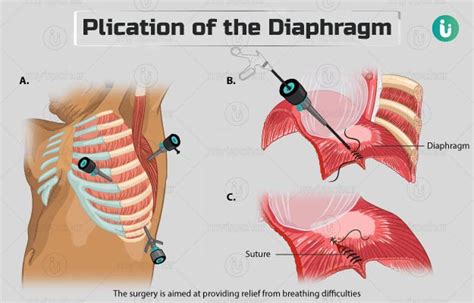 Plication of the Diaphragm: Procedure, Purpose, Results, Cost, Price