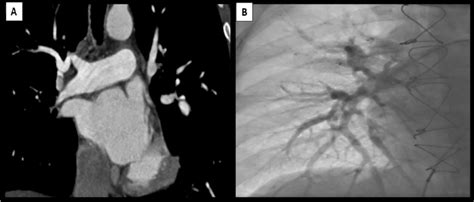 (A) Follow up computed tomography pulmonary angiography showing... | Download Scientific Diagram