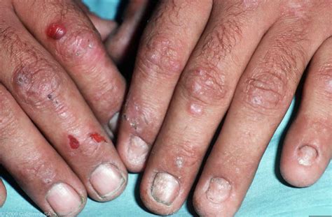 Porphyria cutaneous tarda causes, symptoms, diagnosis & treatment