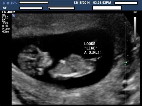 Comfirmed girl ultrasound pic at 12 weeks | BabyCenter