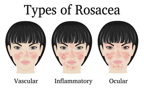 Natural Treatment for Rosacea | Vitalia