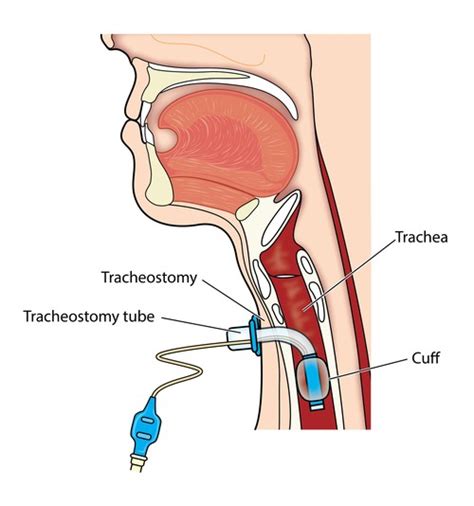 Tracheostomy: Symptoms Complications and Treatment