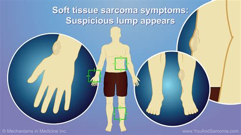 Diagnosing and Treating Soft Tissue Sarcoma