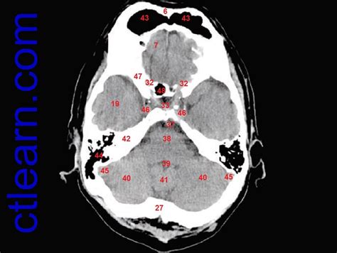 Anatomy CT Axial Brain