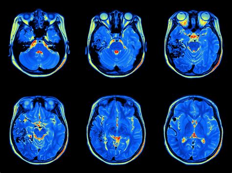 Neuroimaging: Applications in Chronic Pain Management - Clinical Pain Advisor