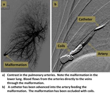 Pulmonary Angiography and Embolization - Interventional Radiology | UCLA Health